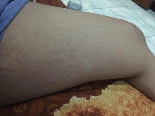 Apalah ini strechmark?