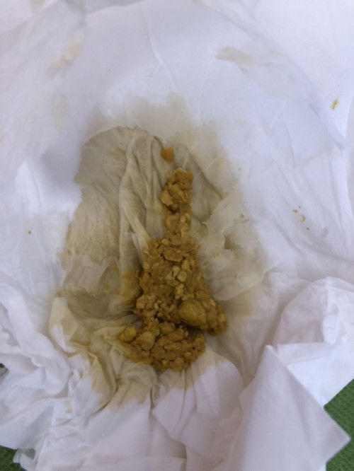 ลูกอึแบบนี้ปกติไหมคะ