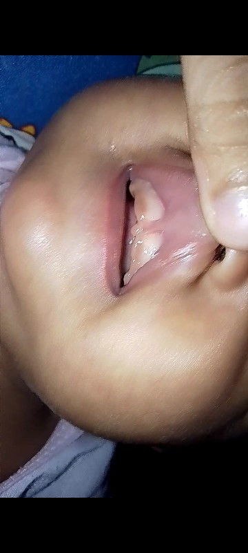 Lip tie apakah bisa sembuh sendiri