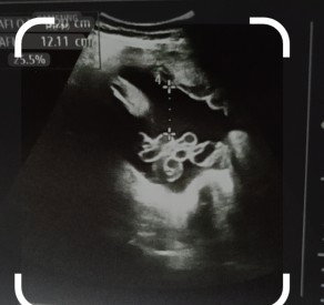 ultrasound picture
