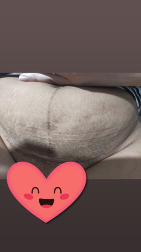 nhạy cảm 1 tí các mom cho e hỏi những đốm đen xung quanh vết mổ là gì và làm sao để mất v ạ