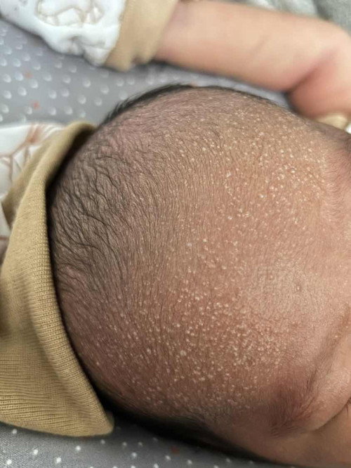 nb 7hari beruntusan?