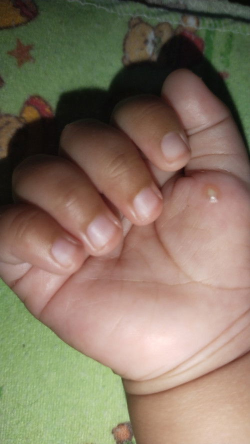 Tangan bentol berair