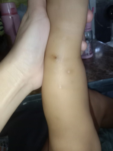 Peklat ng bata