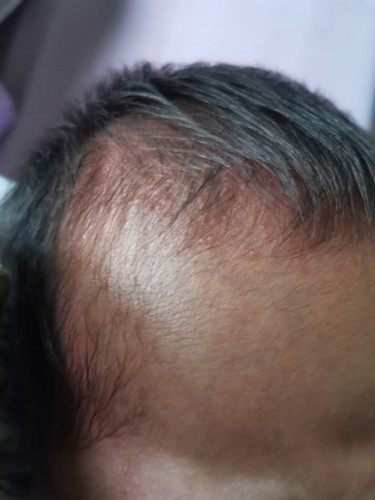 baby acne?