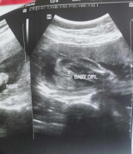 Baby Girl Ultrasound
