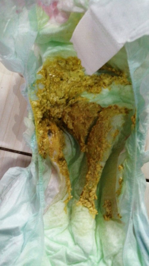 Maaf kalau kotor nak tanya ank baru start mkn dan baru tukar susu klau mcm ni cirit birit tak