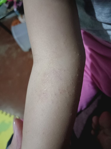 Baby skin problem