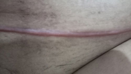 Keloid pda luka operasi sc