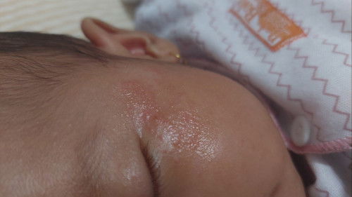 Berutusan diwajah bayi 2 bln