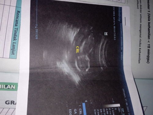 USIA KANDUNGAN 15 MINGGU