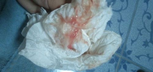 กระคุ้นคลอด