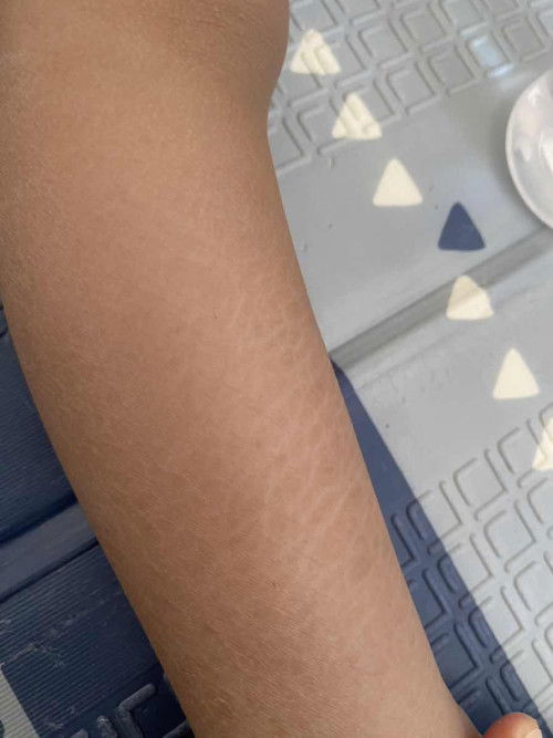 Kulit kering dan retak