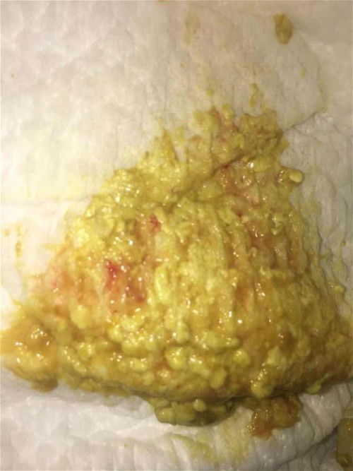 Intoleransi laktosa bab 6x smpe minum SGM llm blm bab”