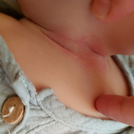 rashes sa leeg