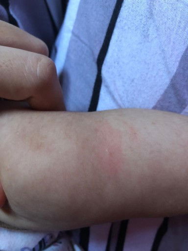 Bentol merah pada bayi