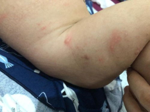 Bentol merah pada bayi