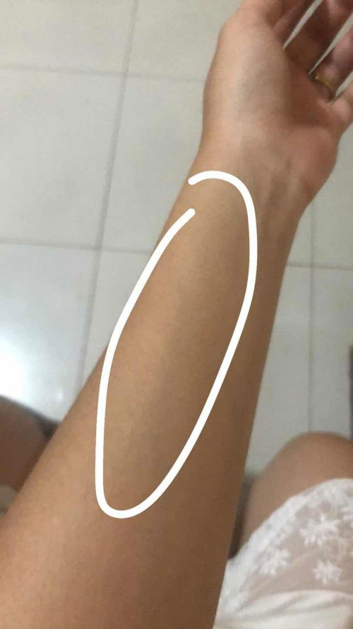Masakit na muscle or ugat sa braso