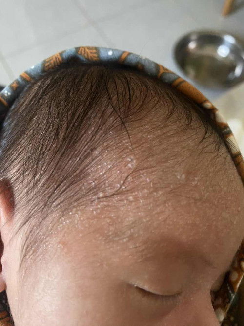 Tekstur di kulit bayi newborn