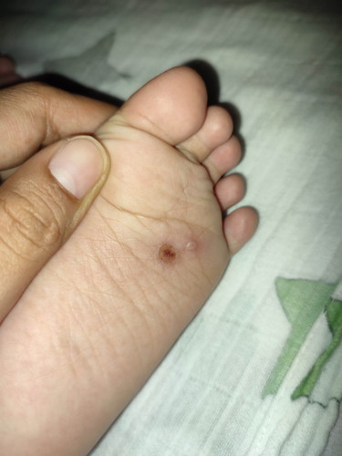 Insect bites
Tanong lang po mga mommy, ano po kaya pede ko ipahid dito.