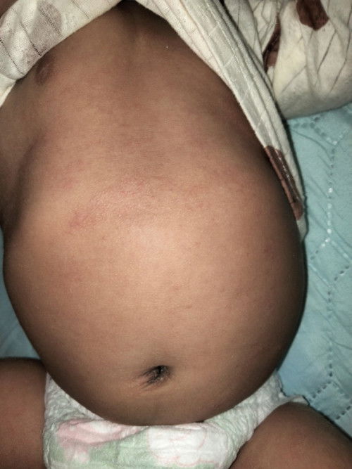 ลูกเราเป็นหวัดบ่อยมาก