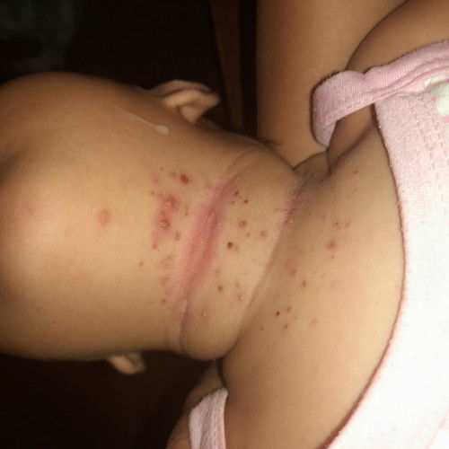 Tumubo sa leeg ng baby ko