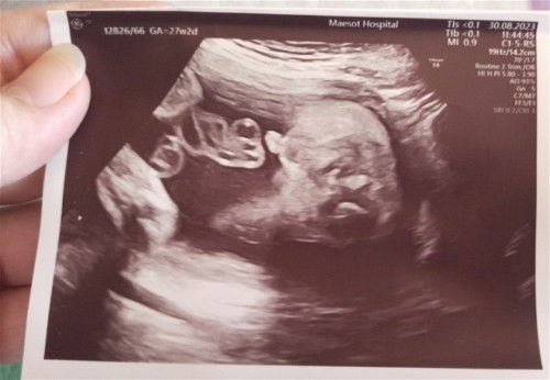 อัลตร้าซาวด์ 27W2D 😍❤️🫄