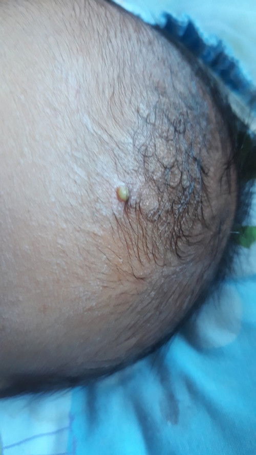 Anak ku baru setengah bulan, di pipi ada bintik2 di kepala ada bintik ijo begitu, kenapa ya?
