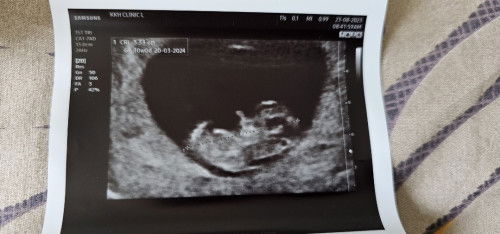 10 weeks ultrasound.. Boy or Girl