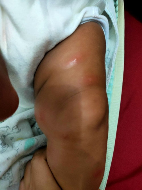 Bentol pada anak