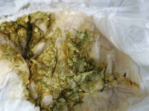 น้อง 6 เดือนถ่ายหนัก (ท้องเสีย)