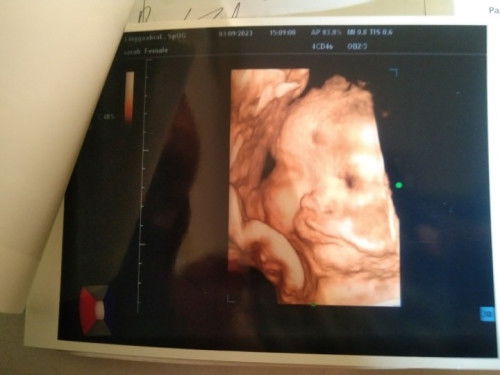 Apa terlihat seperti bibir sumbing .. bantu jawab ya mom