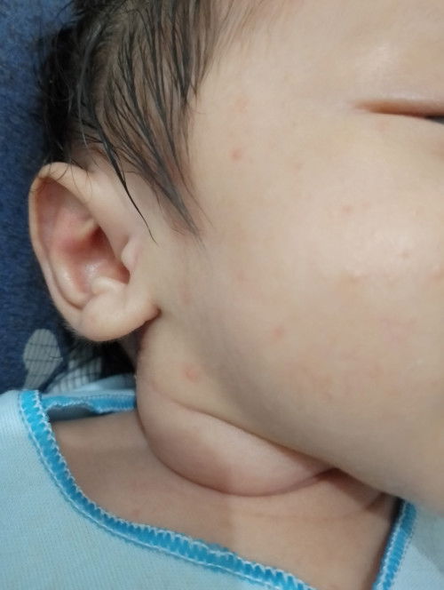 Bengkak di leher bayi