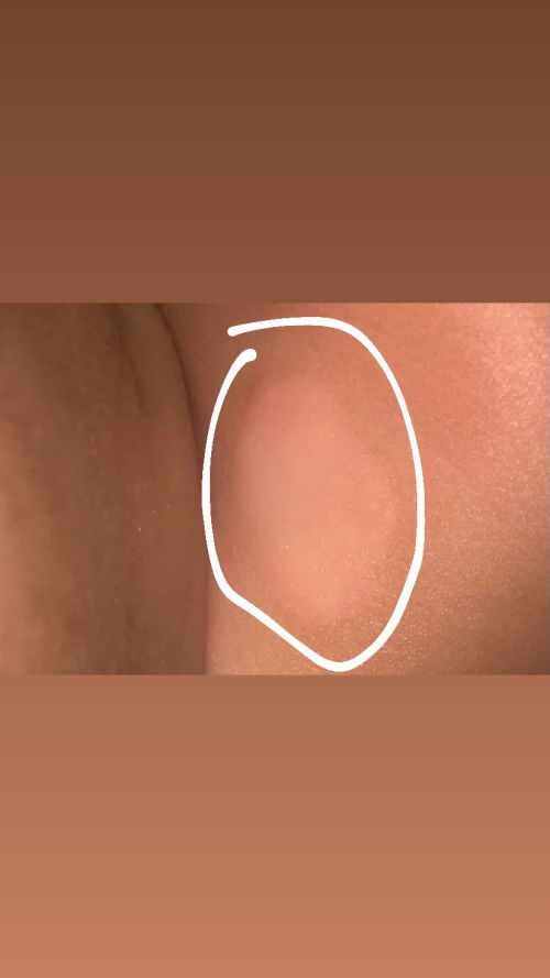 Bercak merah kayak gigit serangga