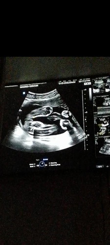 Sure girl na po ba ito? CAS at 25 weeks.