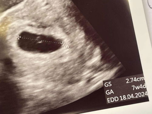 Sharing yokk masalah usg berbagi pengalaman calon bunda