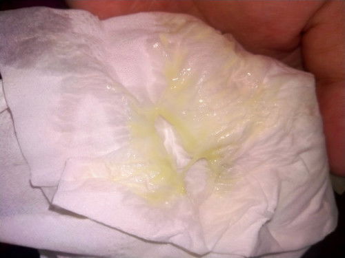 ตกขาวแบบนี้ปกติไหมค่ะ ท้อง3เดือน