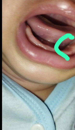 Bintit putih di gusi bayi