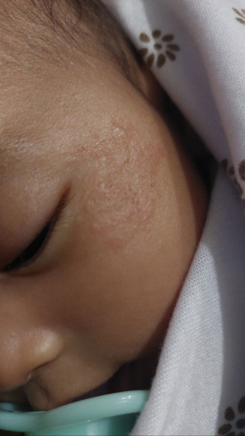 Bayi 2 bulan beruntusan