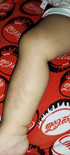 Mga mommies patulong nmn po meron rashes yung baby ko na una po yung rash before yung fever po