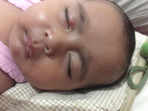 Benjolan pada kelopak Mata