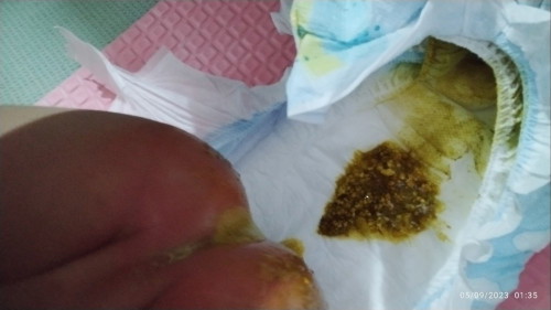 Bakit po parang may bilog bilog yung tae nya mag 5 months palang po sya sa sept 7