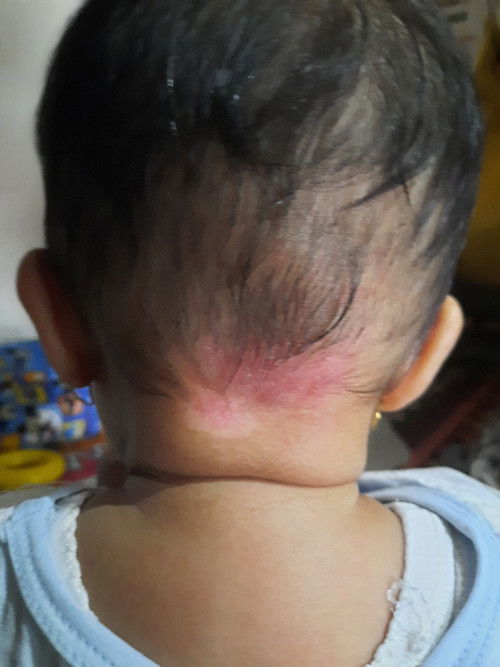 Obatnya apa ya??...
merah,ketombe dan gatal di blkang kepala anak 8 bln