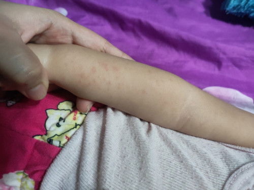 Biang keringat atau alergi