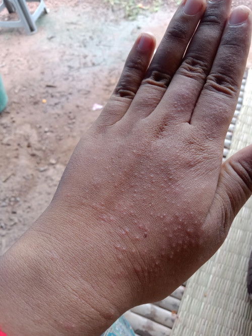 ผื่นขึ้นหลังคลอด