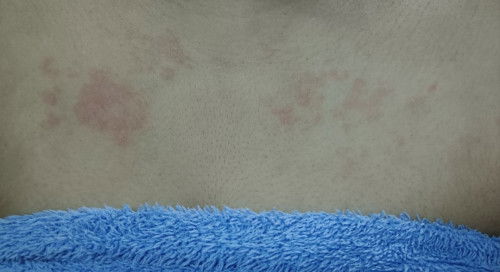 Kulit gatal2 dalam pantang