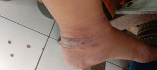 Gatal di kaki jadi kering
