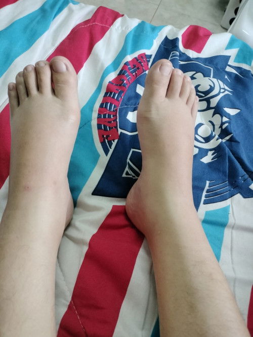 ท้อง 35 วิค แล้วข้อเท้าบวม