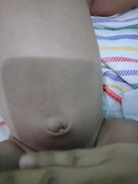 Udel gak sembuh sembuh