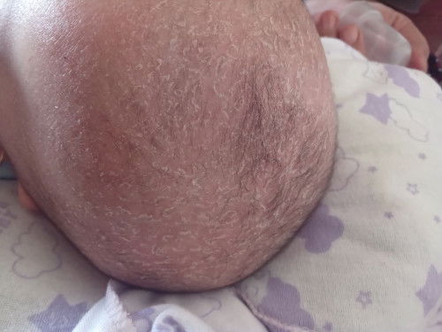 Kulit kepala bayi  3 bulan mengelupas